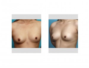 Congenital Breast Asymmetry Dr Barry Eppley Indianapolis