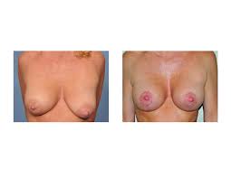 Indianapolis Breast Lifts with Implants Dr Barry Eppley