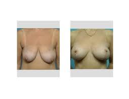 Indianapolis Breast Lifts with Implants Dr Eppley