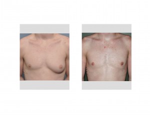 Large Breast Tumor Gynecomastia Excision result front view Dr Barry Eppley Indianapolis