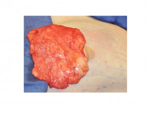 Large Gynecomstia Breast Tumor Excision Dr Barry Eppley Indianapolis