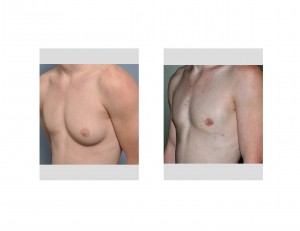 Large Unilateral Gynecomastia Excision result oblique view Dr Barry Eppley Indianapolis