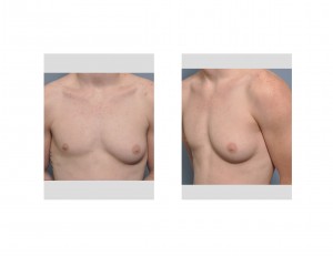 Large Unilaterall Gynecomastia in Young Male Dr Barry Eppley Indianapolis