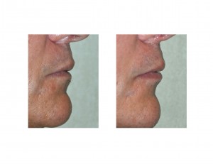 Male Lip Implant result side view Dr Barry Eppley Indianapolis