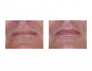 Male Lip Implant results front views Dr Barry Eppley Indianapolis