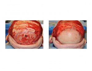 Occipital PMMA Cranioplasty result back view