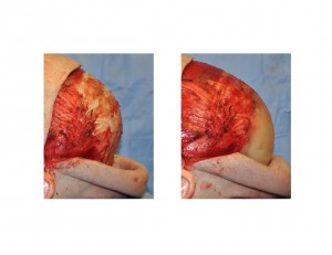 Occipital PMMA Cranioplasty result side view