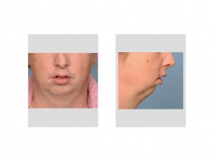 Severe Chin and Jaw Deficiency Dr Barry Eppley Indianapolis