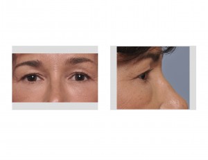 Aging Upper Eyes Dr Barry Eppley Indianapolis
