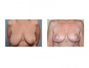 Breast Lift Indianapolis Dr Barry Eppley
