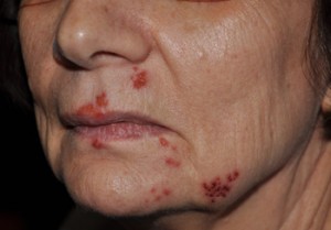 Cold Sores after Laser Resurfacing Dr Barry Eppley Indianapolis