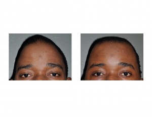 Cranioplasty Result forTriangular Skull Deformity Dr Barry Eppley Indianapolis