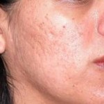Facial Acne Scars Dr Barry Eppley Indianapolis
