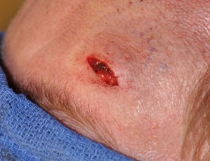 Forehead Lipoma Dr Barry Eppley Indianapolis