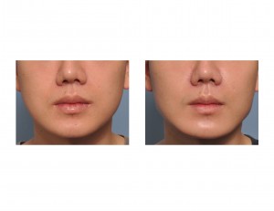 Jaw Angle Implant Results front view