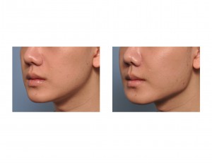 Jaw Angle Implant Results oblique view