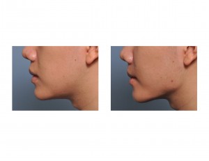 Jaw Angle Implant Results side view