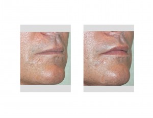 Labiomental Fold Augmentation result oblique view Dr Barry Eppley Indianapolis