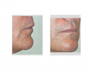 Labiomental Fold Deformity Dr Barry Eppley Indianapolis