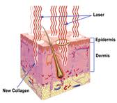 Laser Resurfacing Indianapolis Dr Barry Eppley