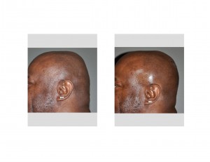Occipital Cranioplasty result siude view Dr Barry Eppley Indianapolis