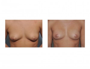 Periareolar Reduction result front view