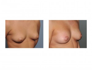 Periareolar Reduction result oblique view Dr Barry Eppley Indianapolis
