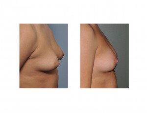 Periareolar Reduction result side view Dr Barry Eppley Indianapolis