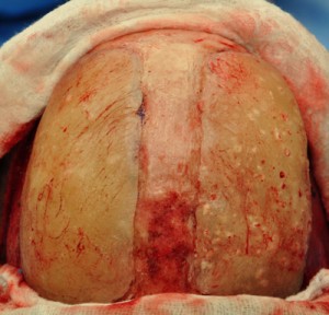 Skull Cranioplasty for Triangular Head Deformity Dr Barry Eppley Indanapolis