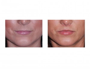 Subnasal Lip Lift result three months front view