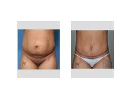 Tummy Tuck Surgery Indianapolis Dr Barry Eppley