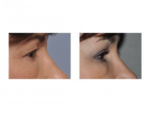 Upper Eyelid Lifts under Local results side view Dr Barry Eppleuy Indianapolis