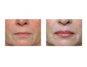 Vermilion Lip Lift