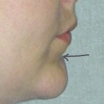 labiomental fold dr barrye eppley indianapolis