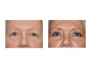 Blepharoplasty Surgery result front view Dr Barry Eppley Indianapolis