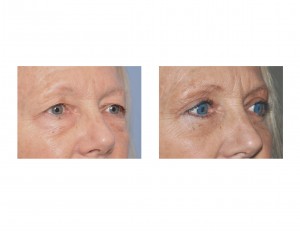 Blepharoplasty Surgery result oblique view Dr Barry Eppley Indianapolis