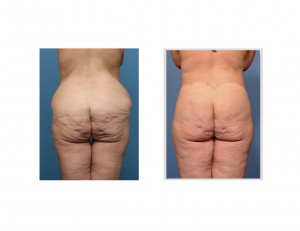 Circumferential Body Lift results back view