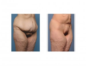 Circumferential Body Lift results oblique view