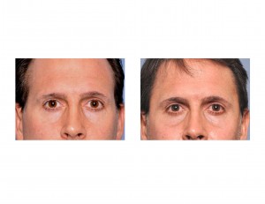 Eppley Temporal Implants result front view