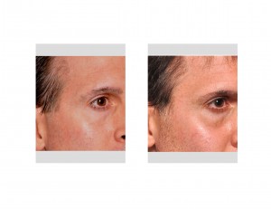 Eppley Temporal Implants result oblique view