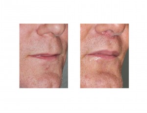 Male Lip Lift result Dr Barry Eppley Indianapolis oblique view