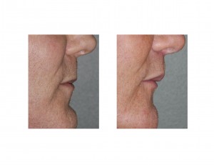 Male Lip Lift result Dr Barry Eppley Indianapolis side view