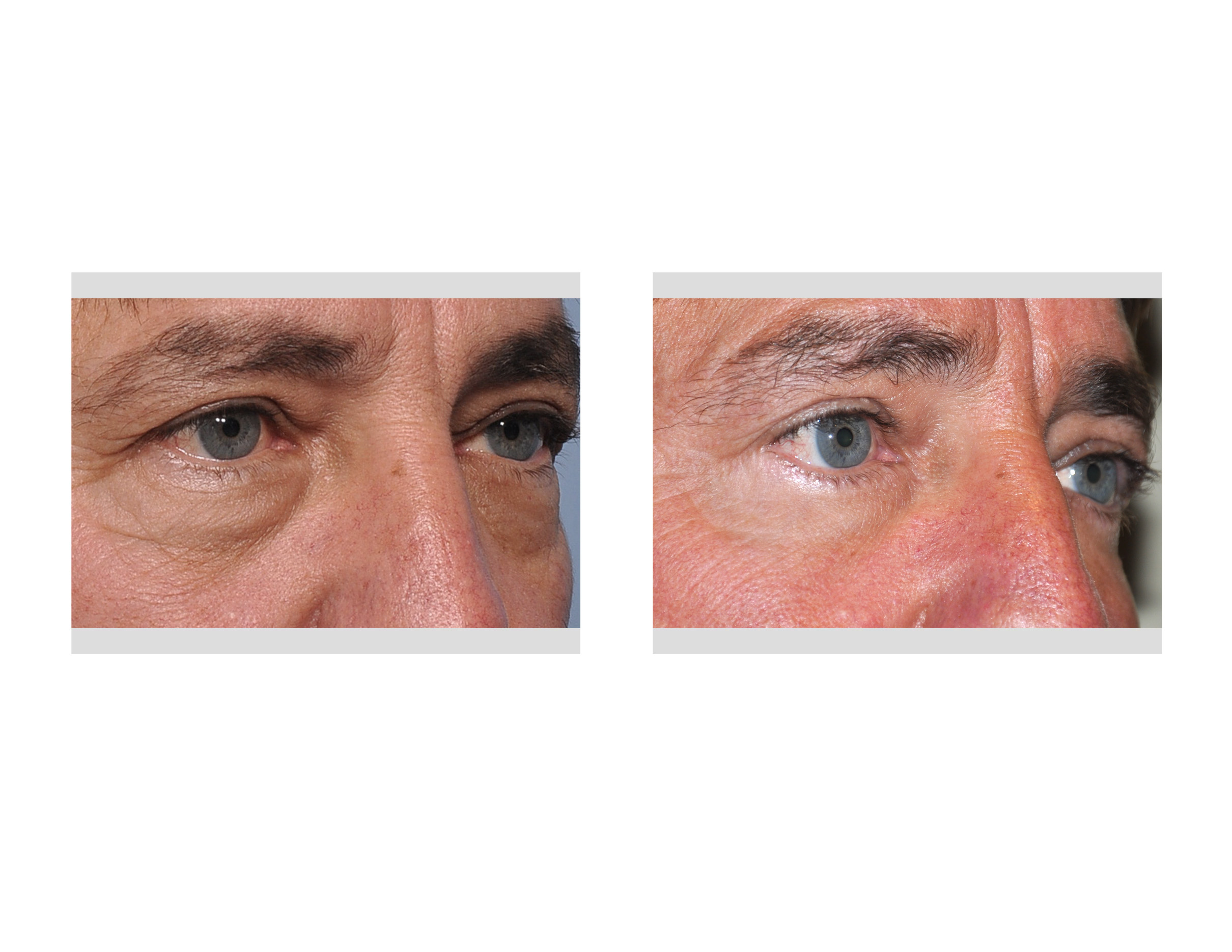 archive for the blepharoplasty category
