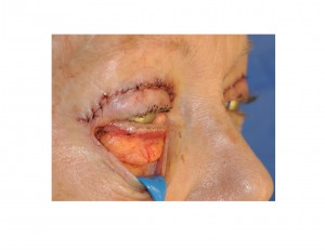 Protruding Lower Eyelid Fat Dr Barry Eppley Indianapolis