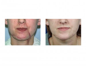 Scar Revision Face Dr Barry Eppley Indianapolis