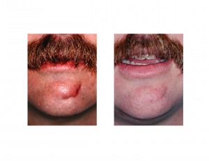 Scar Revision Face Indianapolis Dr Barry Eppley