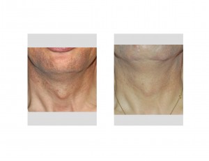 Tracheal Reduction Dr Barry Eppley Indianapolis
