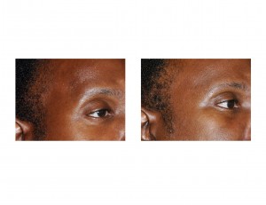 tw temporal implant results right oblique view