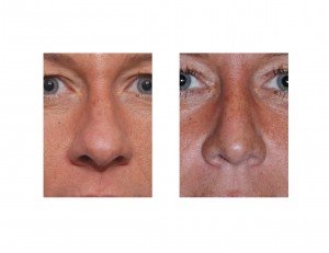 Broad Nasal Tip Rhinoplasty results front view Dr Barry Eppley Indianapolis