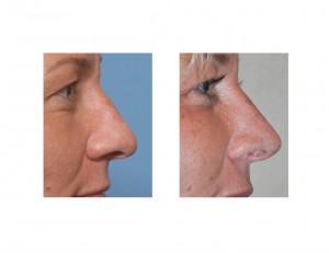 Broad Nasal Tip Rhinoplasty results side view